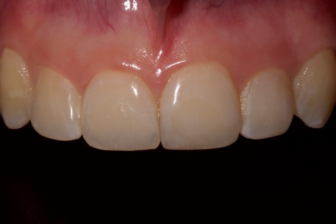 Cosmetic Bonding Halifax, NS Dr. Jenine Arab Omalley